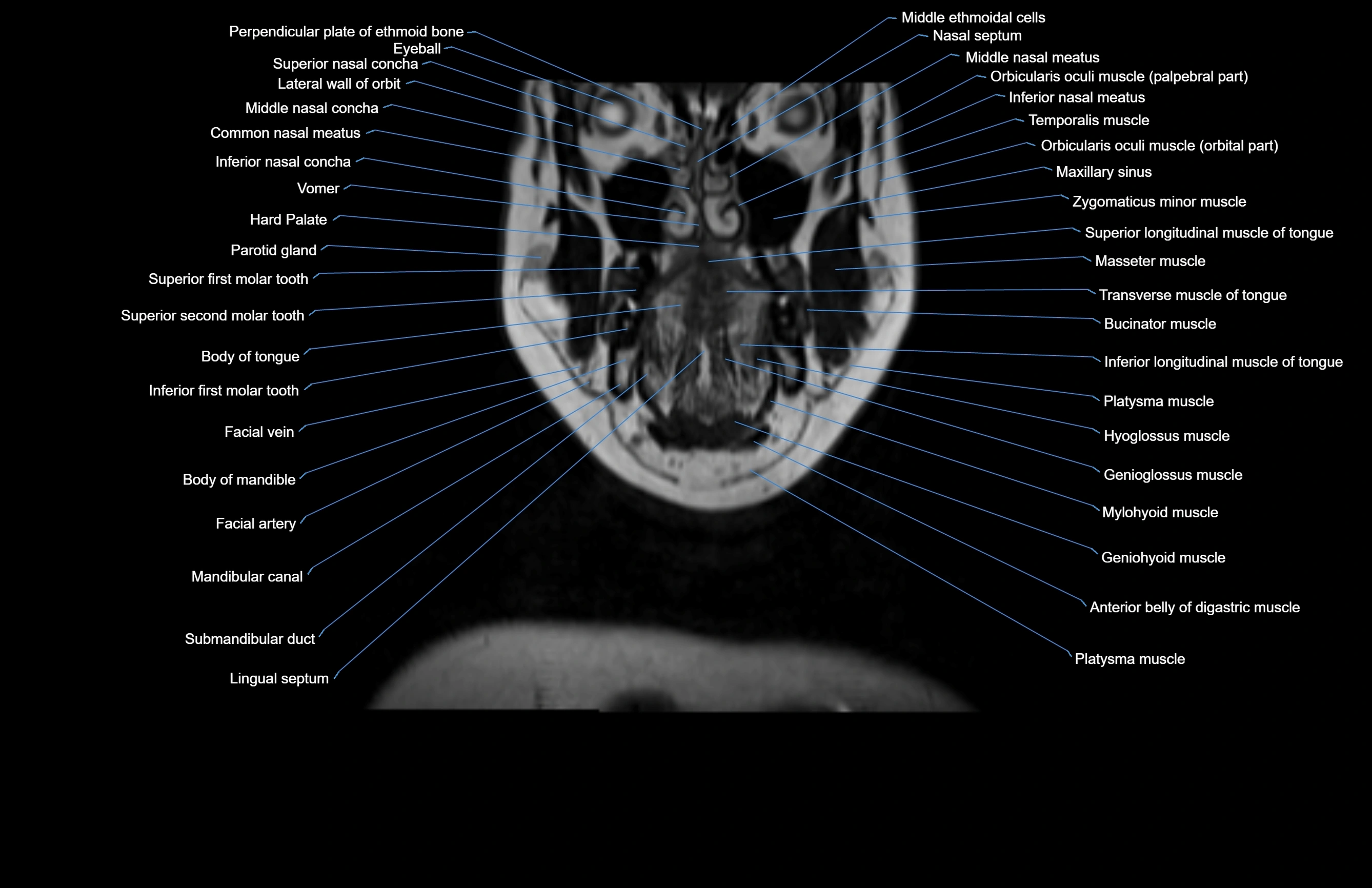 Neck coronal cross sectional MRI anatomy 3T MRI  image-img-00001-00060.webp